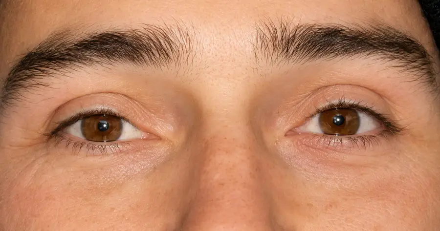 Ocular Prosthesis After by Vida Trümpelmann