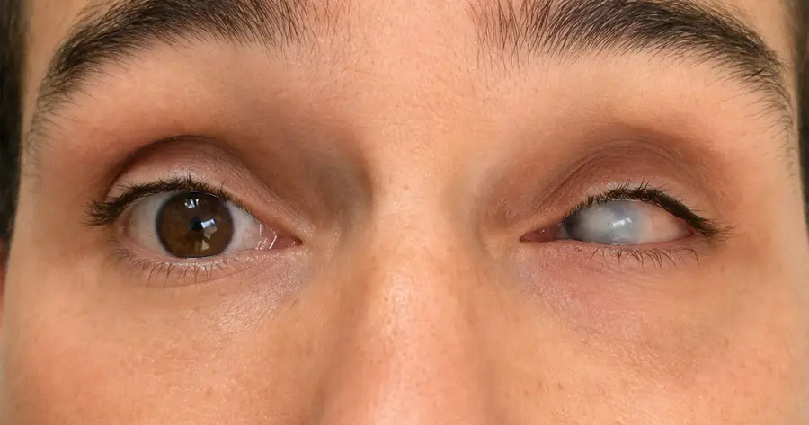 Ocular Prosthesis Before by Vida Trümpelmann