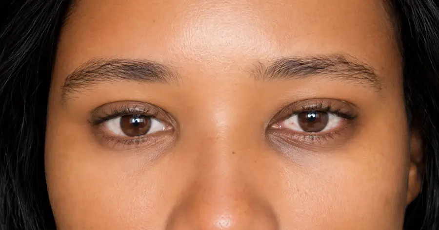 Ocular Prosthesis After by Vida Trümpelmann