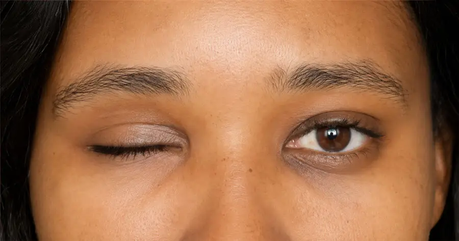 Ocular Prosthesis Before by Vida Trümpelmann