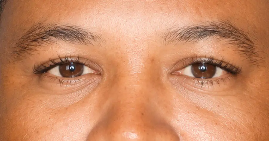 Ocular Prosthesis After by Vida Trümpelmann