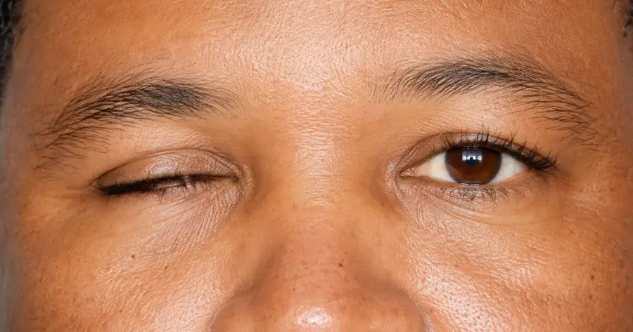 Ocular Prosthesis Before by Vida Trümpelmann
