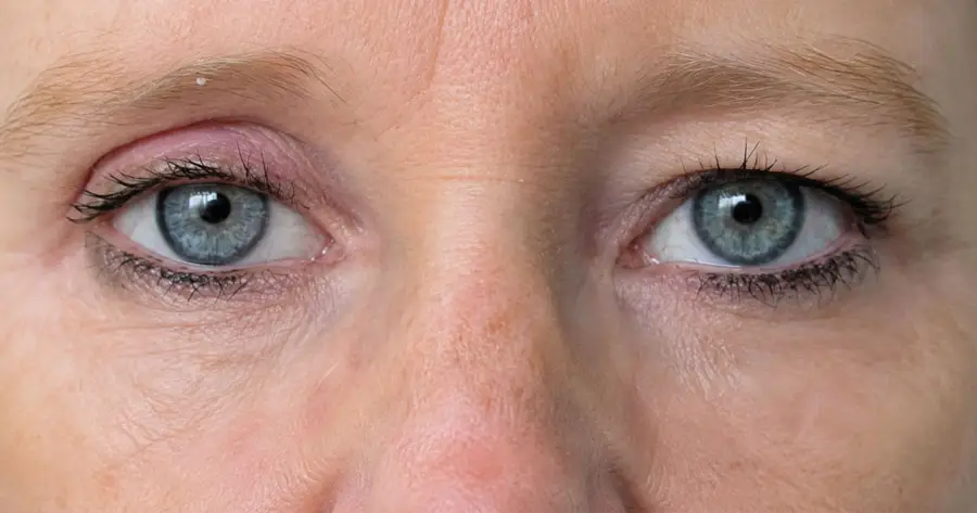 Ocular Prosthesis After by Vida Trümpelmann