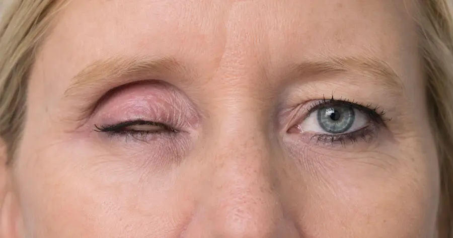 Ocular Prosthesis Before by Vida Trümpelmann