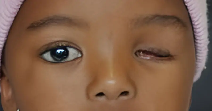 Ocular Prosthesis Before by Vida Trümpelmann