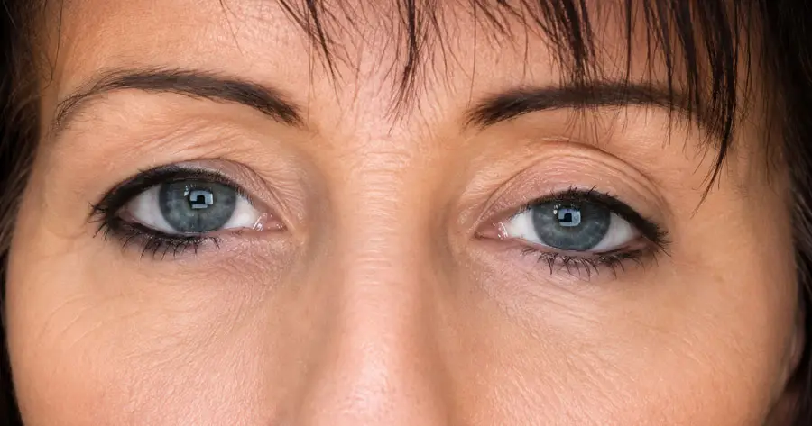 Ocular Prosthesis After by Vida Trümpelmann