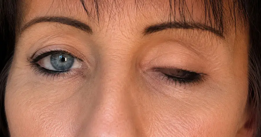 Ocular Prosthesis Before by Vida Trümpelmann