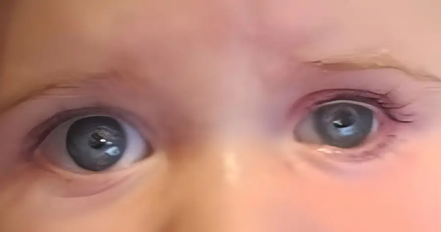 Ocular Prosthesis After by Vida Trümpelmann