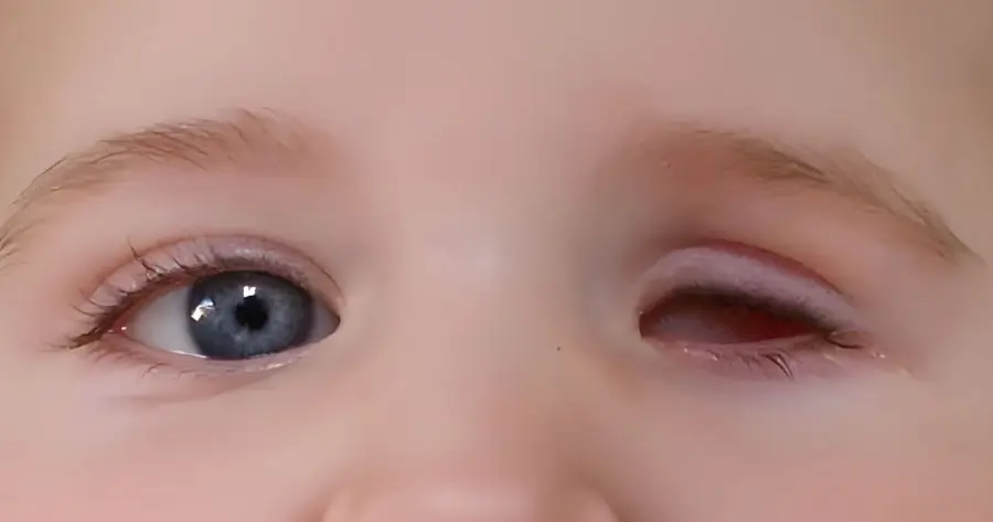 Ocular Prosthesis Before by Vida Trümpelmann