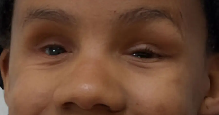 Ocular Prosthesis After by Vida Trümpelmann