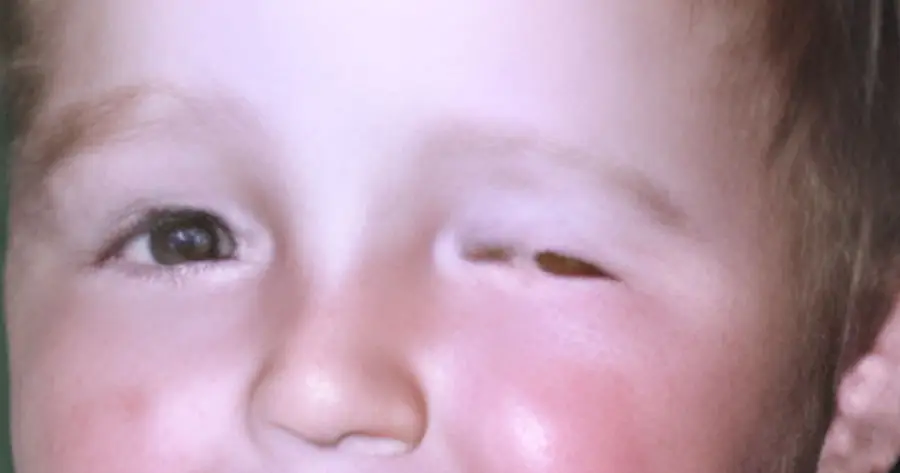 Ocular Prosthesis Before by Vida Trümpelmann