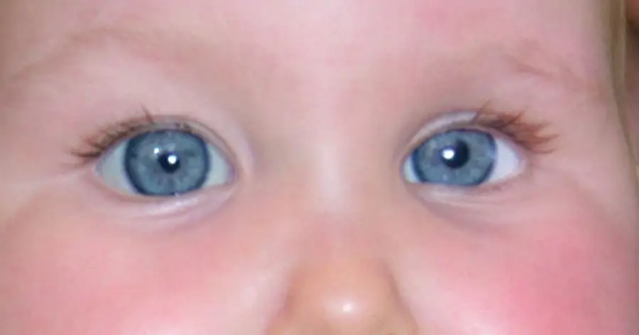 Ocular Prosthesis After by Vida Trümpelmann