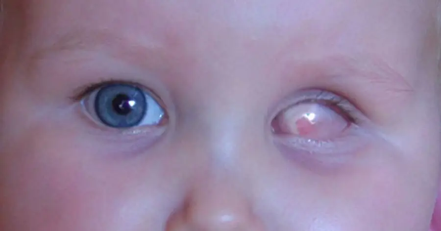 Ocular Prosthesis Before by Vida Trümpelmann