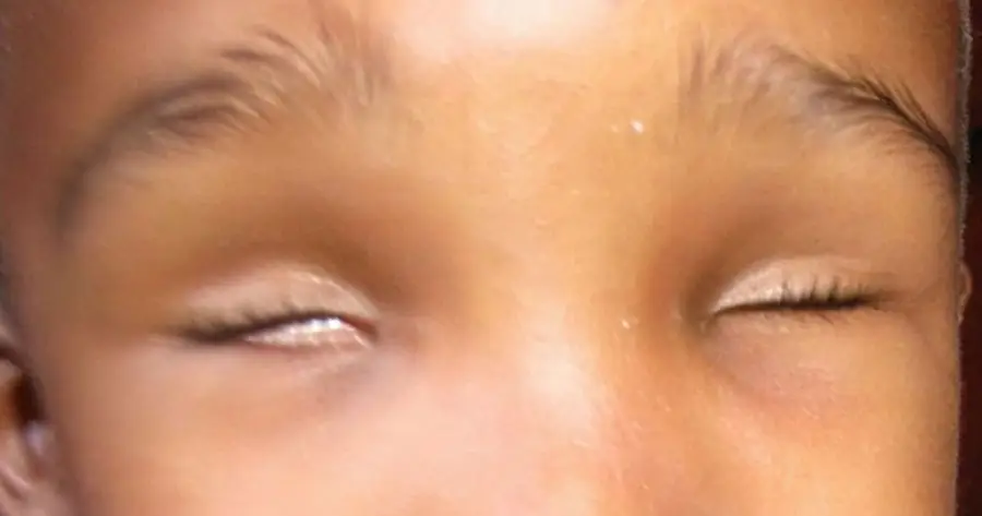 Ocular Prosthesis Before by Vida Trümpelmann