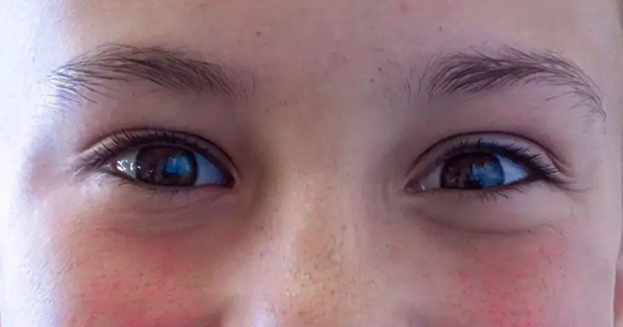 Ocular Prosthesis After by Vida Trümpelmann
