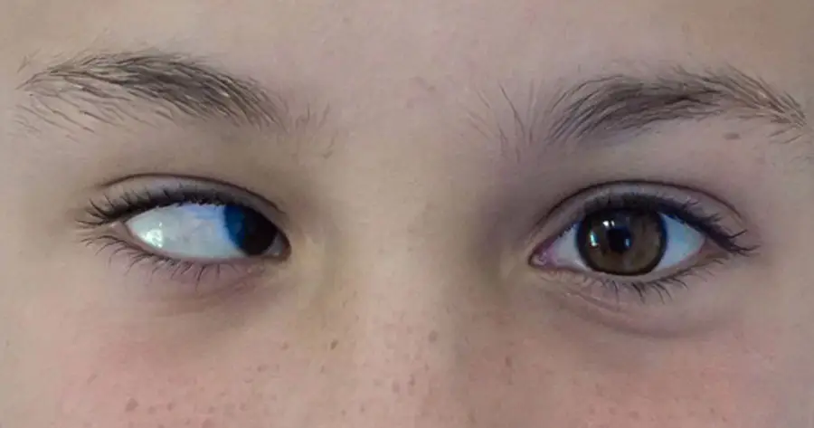Ocular Prosthesis Before by Vida Trümpelmann