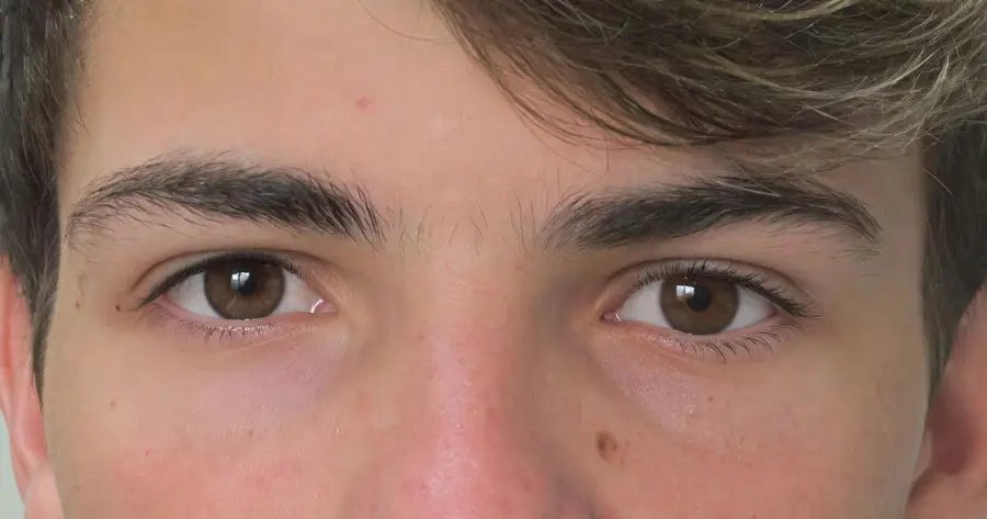 Ocular Prosthesis After by Vida Trümpelmann