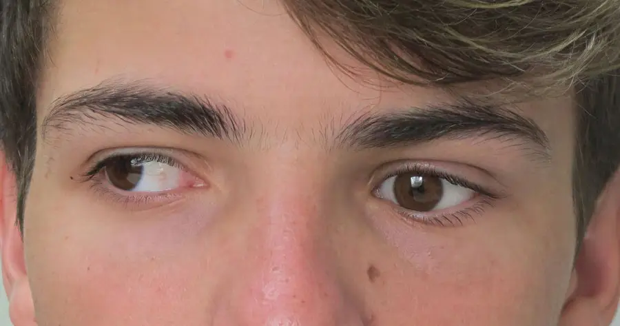 Ocular Prosthesis After by Vida Trümpelmann