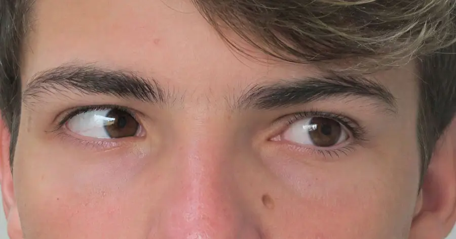 Ocular Prosthesis After by Vida Trümpelmann