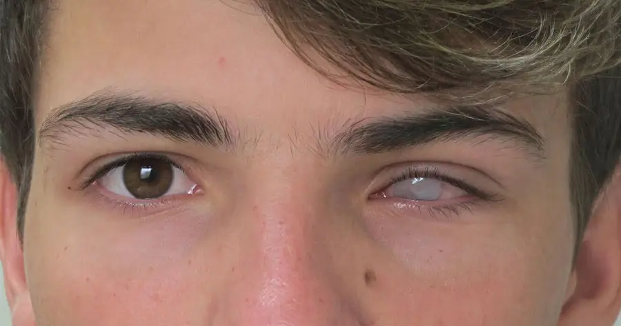 Ocular Prosthesis Before by Vida Trümpelmann