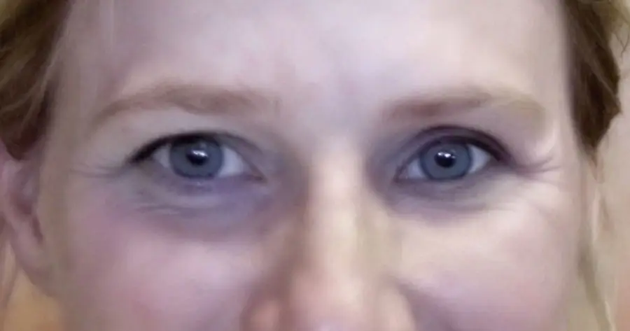 Ocular Prosthesis After by Vida Trümpelmann