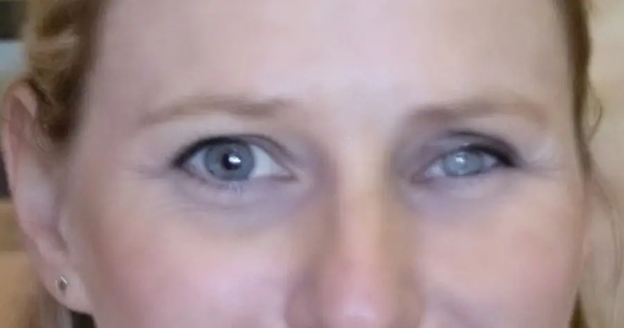 Ocular Prosthesis Before by Vida Trümpelmann