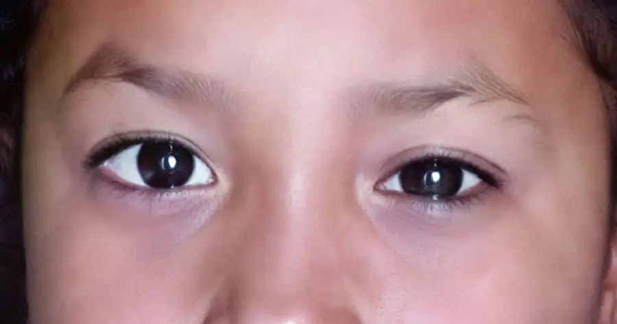 Ocular Prosthesis After by Vida Trümpelmann