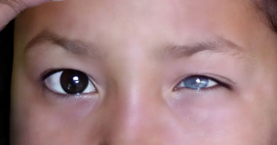 Ocular Prosthesis Before by Vida Trümpelmann