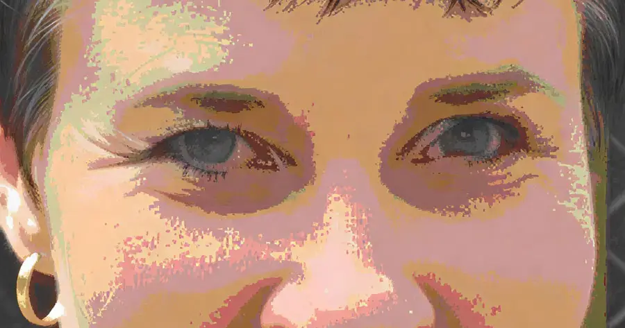 Ocular Prosthesis After by Vida Trümpelmann