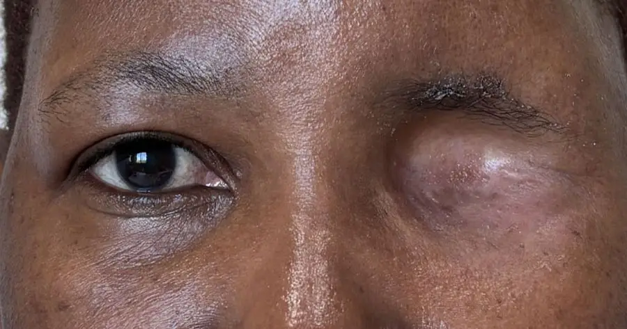 Facial Onlay Prosthesis by Vida Trümpelmann