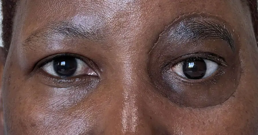 Facial Onlay Prosthesis by Vida Trümpelmann