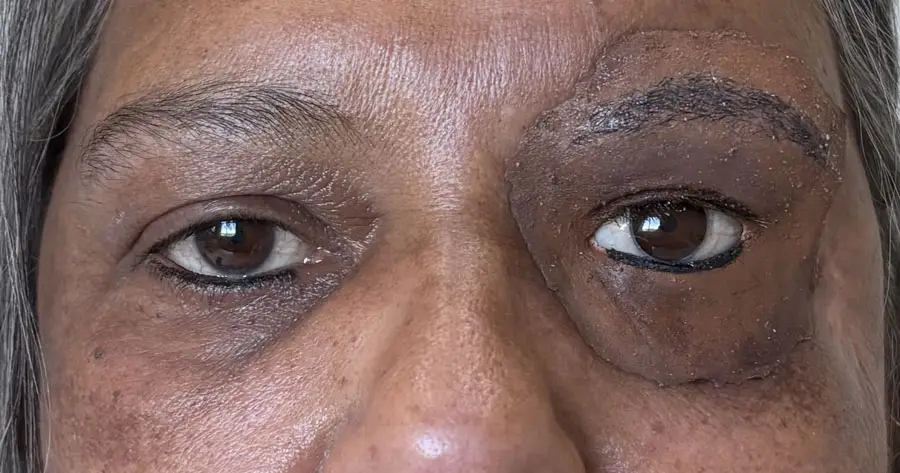 Facial Prosthesis by Vida Trümpelmann
