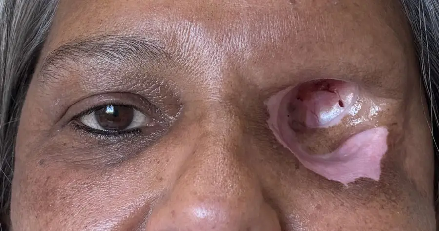 Facial Prosthesis by Vida Trümpelmann